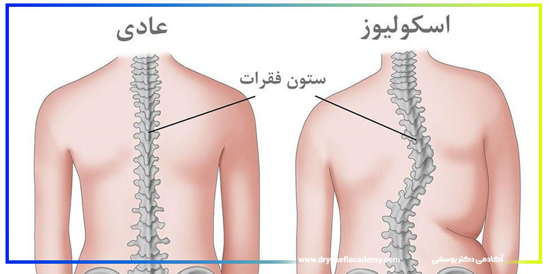 اسکولیوز چیست؟