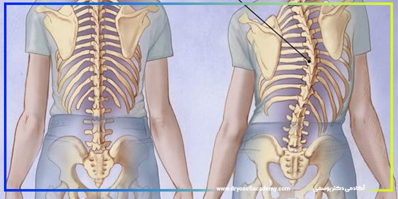 اسکولیوز چیست؟ بررسی علل، نشانه‌ها و روش‌های درمان انحراف ستون فقرات