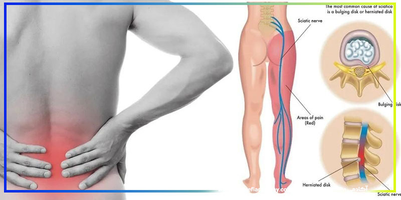 درد سیاتیک چیست و چگونه ایجاد میشود؟